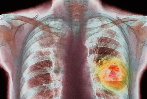 Люди, живующие в горной местности, меньше подвержены раку легких
